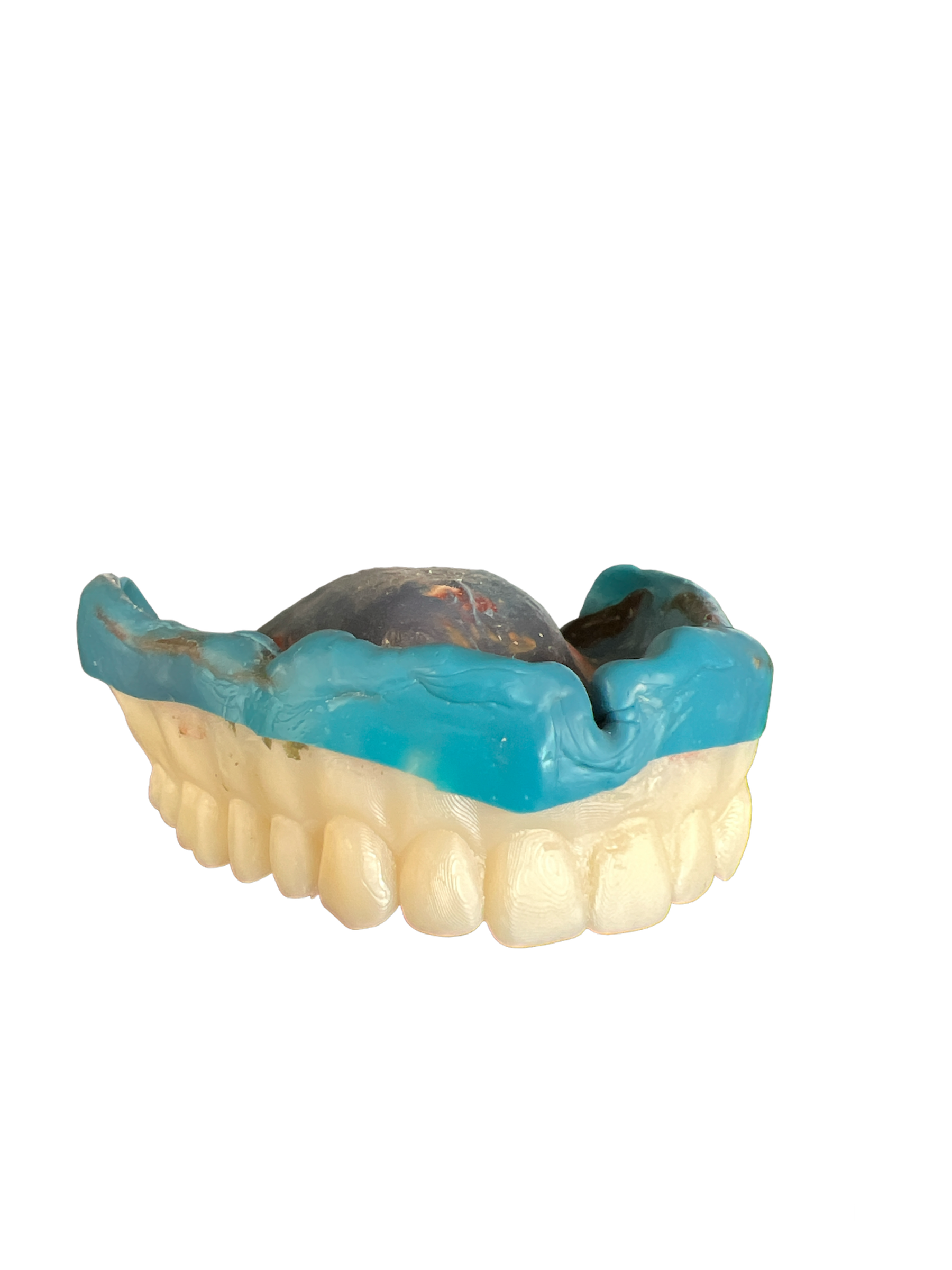 Removable Restorations DigiPros Dental Laboratory